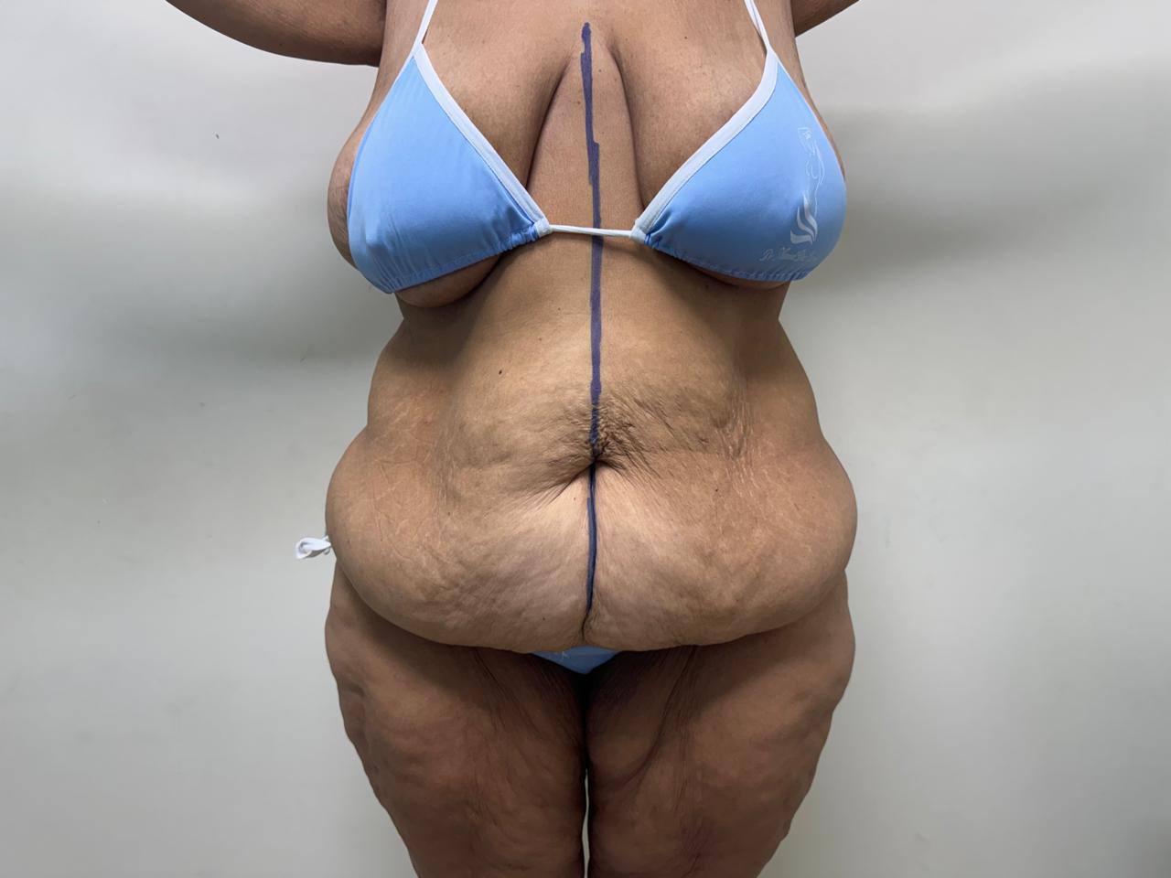 Antes — Abdominoplastia