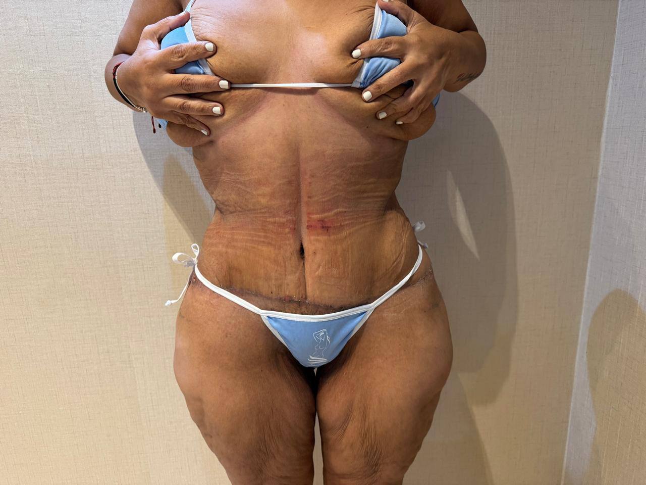 Después — Abdominoplastia