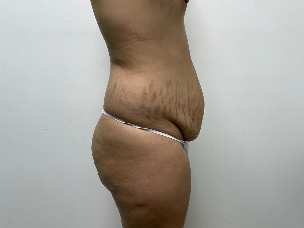 Antes — BBL y Contorno Corporal
