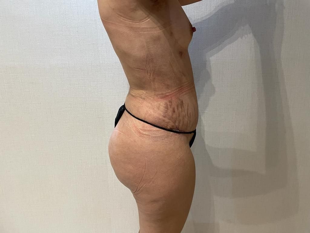 Después — BBL y Contorno Corporal