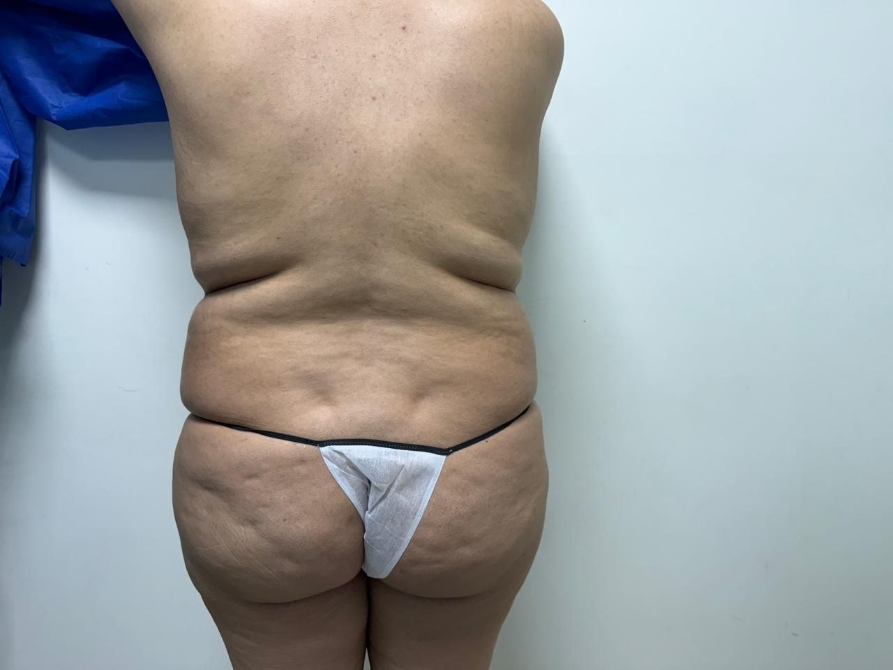 Antes — BBL y Contorno Corporal